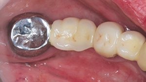 Posterior Bridge