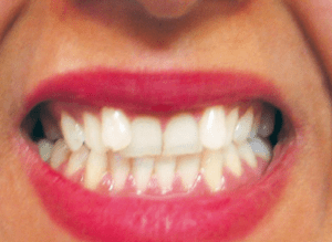 Patient  Before Cosmetic  Dentistry