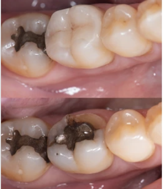 Step by Step Dental Filling (Cavity Filling - Tooth Filling): Cusp Build-Up  of a Molar 