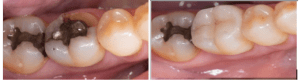 dental fillings