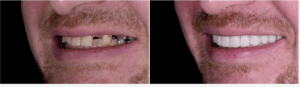 Dental Bridges