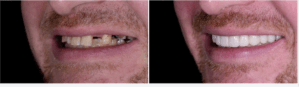 Dental Bridges