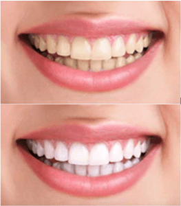 before and after Zoom Teeth Whitening