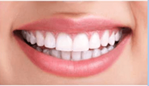 After Whitening