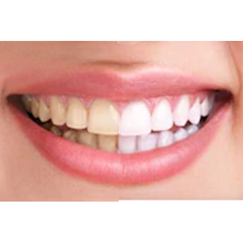 showing whitening half of the mount