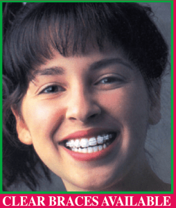The invisible way to straighten your teeth with clear braces or clear aligners