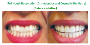Full mouth restoration (Orthodontics and Cosmetic Dentistry)
