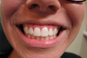 Spaced Anterior Teeth (Before & After)