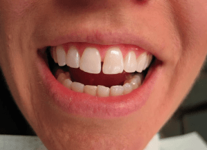 Dental Bonding Before:Teeth with spaces