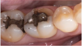 molar teeth with amalgam fillings