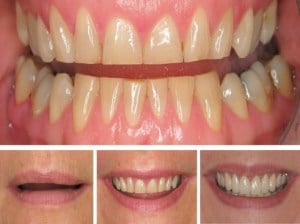 signs of dental wear