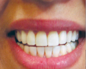 Completed mouth restoration