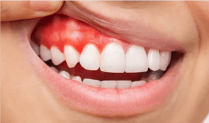 Signs of Gum Disease compared with healthy gums...
