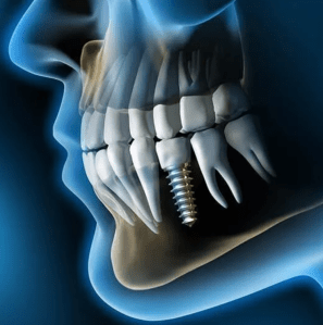Picture  with  Dental  Implant  
