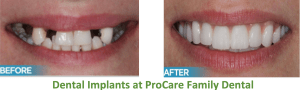 Before and after replacing missing teeth with dental implants