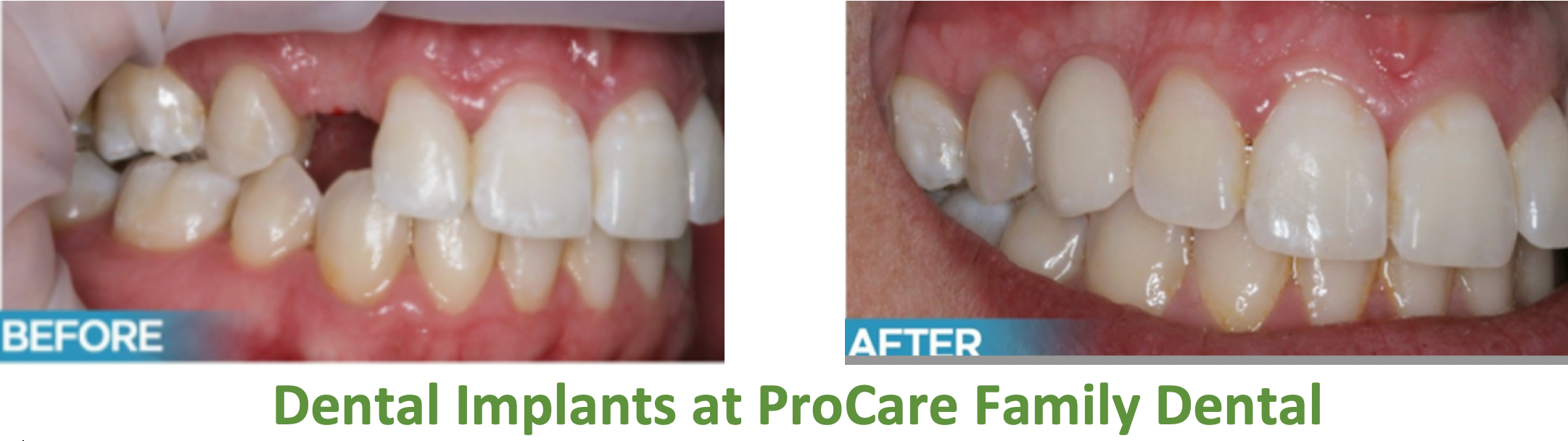 Dental Implants Morton Grove IL, Missing Teeth ProCare Family Dental