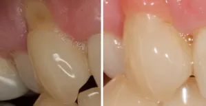 Tooth Abrasion