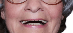 Lady  smiling  with  Old  Dentures  need  to  be  replaced