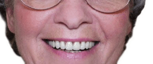 Replaced old Dentures with New Cosmetic Dentures