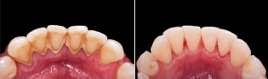 Gum  treatment  in  Morton  Grove