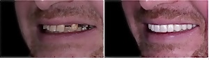 Anterior  Porcelain Bridge before and After