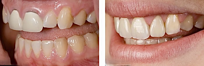 Porcelain Dental Crowns  and  Bridges