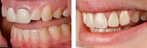 Morton Grove Dental Crowns