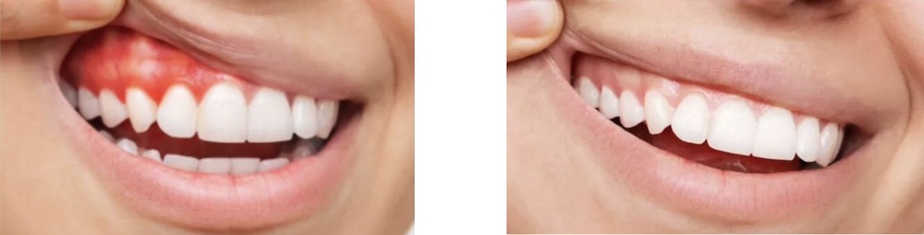 Person  with  Gingivitis  before  and  after  treatment