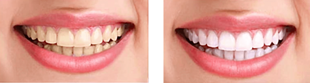 Before and After tooth whitening from ProCare Family Dental