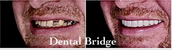 Man  with  Dental  Bridge