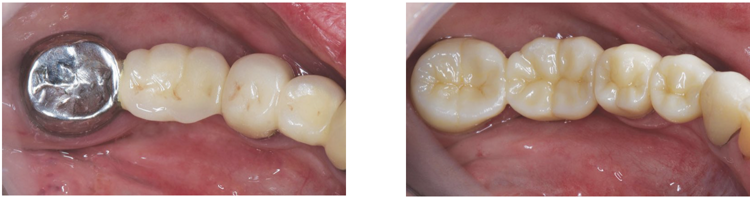 Posterior  Porcelain  Dental  Bridge  from ProCare Family Dental