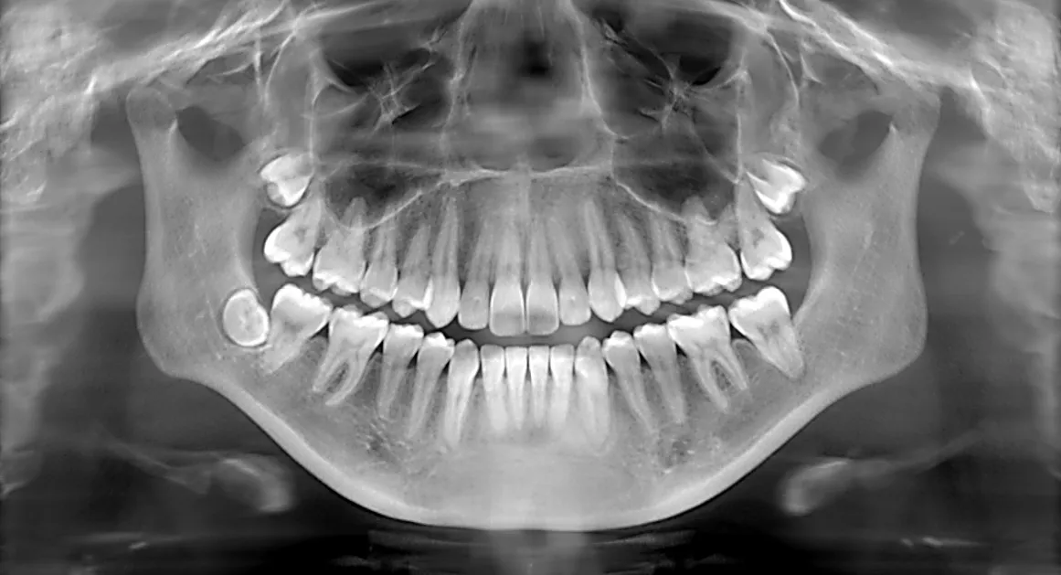 Digital panoramic dental X-ray showing full mouth imaging at ProCare Family Dental
