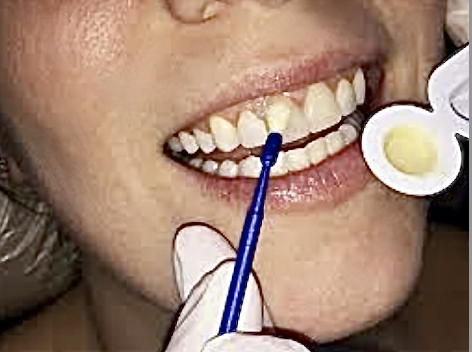 Hygienist applying Flouride on Adult patient