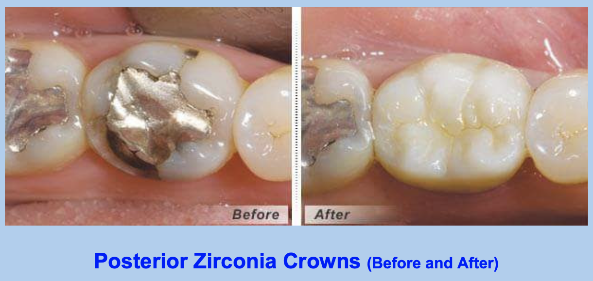 Porcelain  Crowns