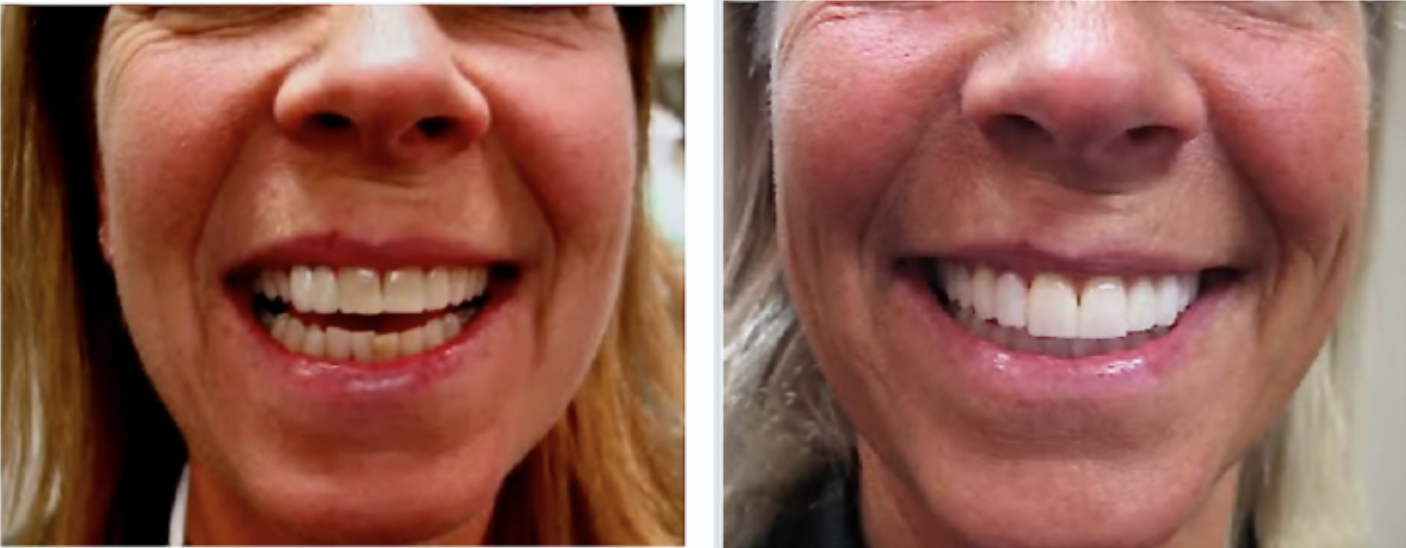 Woman  smiling  after  Dental  Veneers