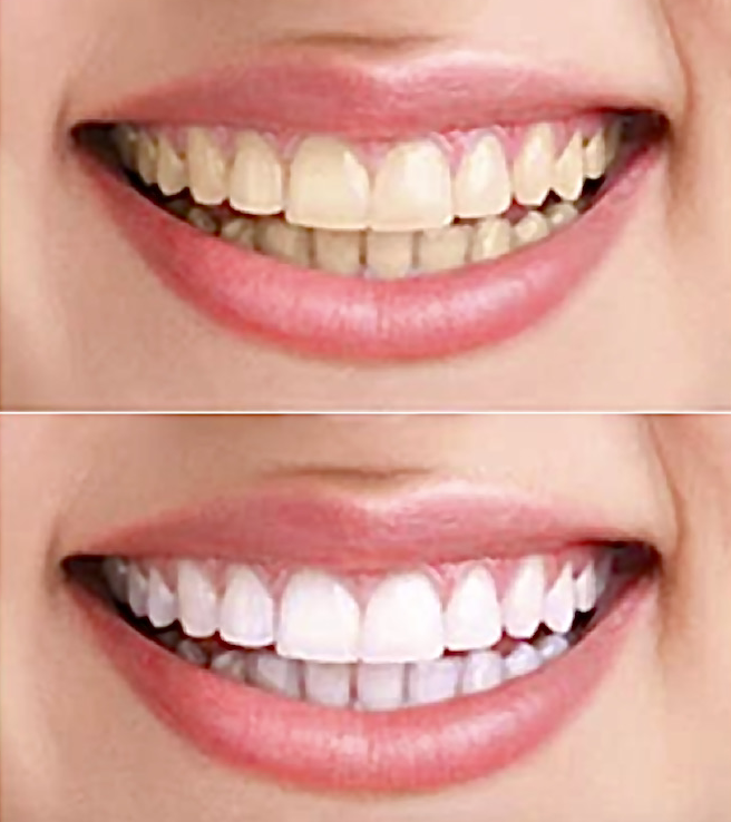 Teeth  whitened  (Before  and  After)