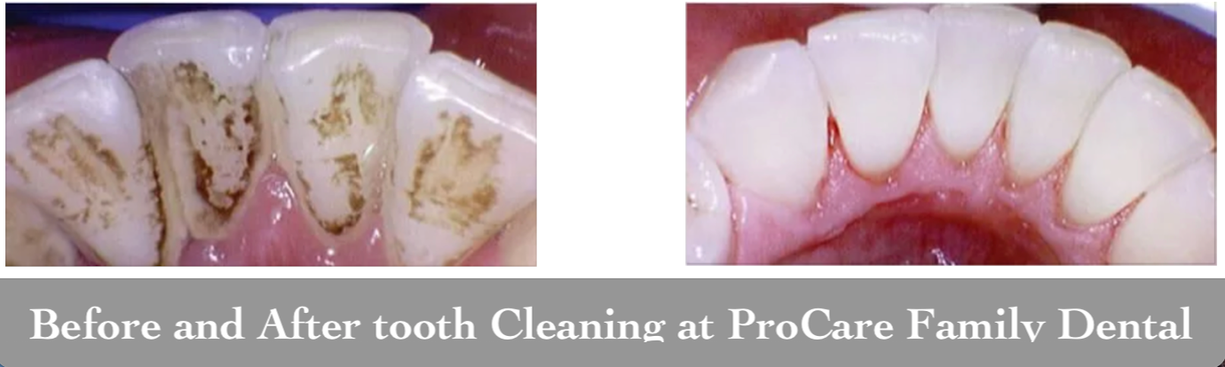 Before and after teeth cleaning by ProCare Family Dental