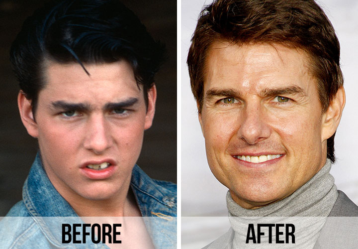 Tom Cruise smile makeover