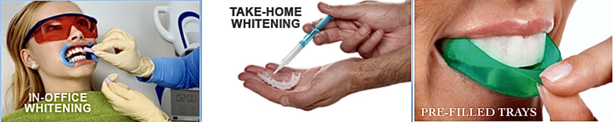 Tooth Whitening Methods at Procare Family Dental