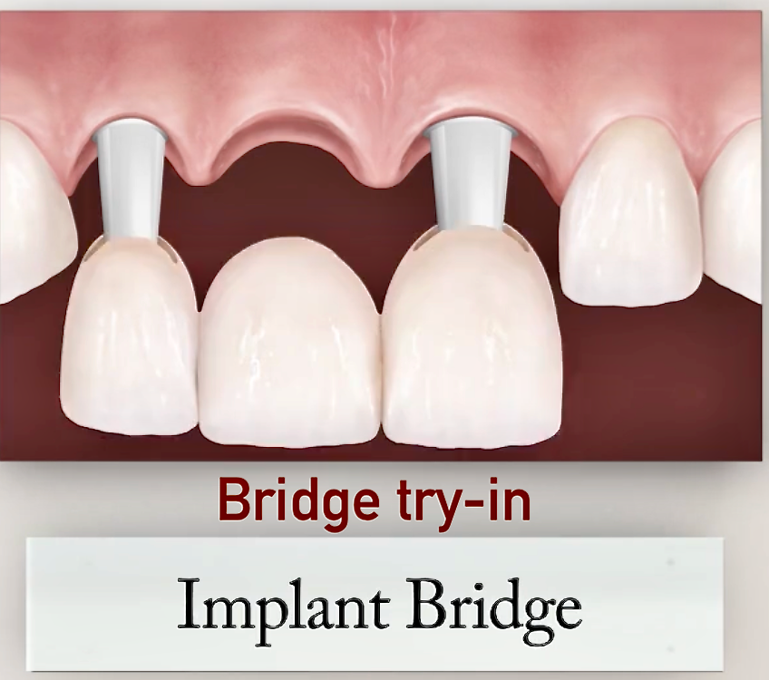 Implant bridge try-in