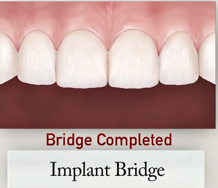 Completed implant bridge