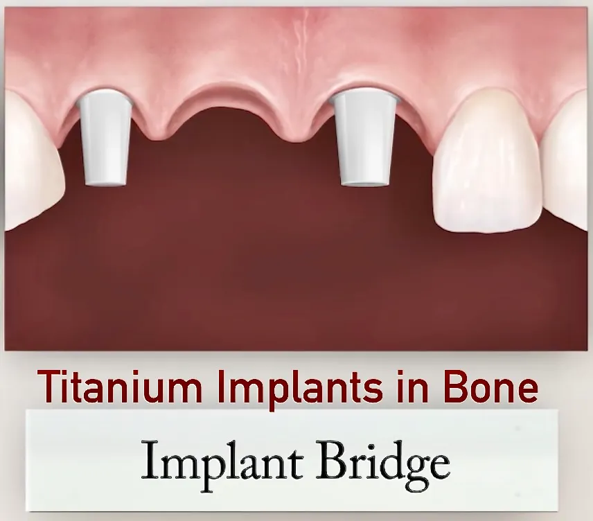 Dental implant in bone