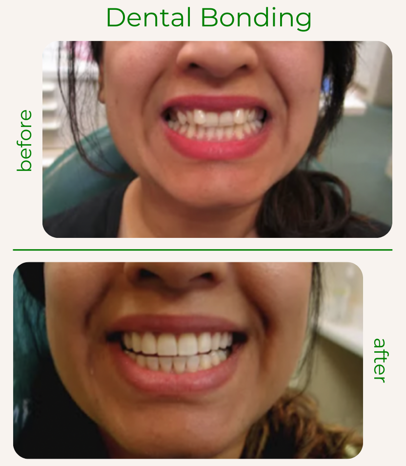 ProCare Family Dental Before and After Dental Bonding