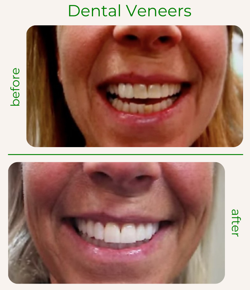 ProCare Family Dental Cathy Before and After Porcelain Veneers