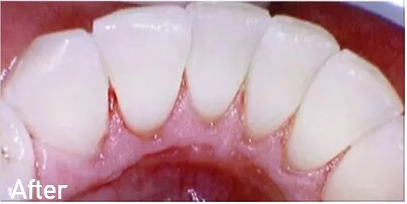After dental cleaning