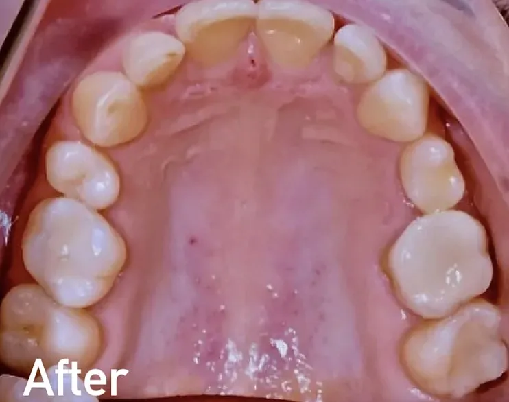 After filling replacement