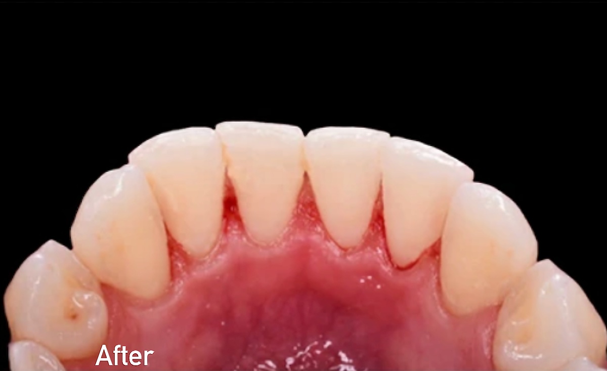 Healthy gums and clean teeth after professional gum disease treatment at ProCare Family Dental