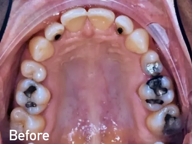 Before filling replacement