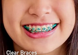 Elise smiling with clear braces orthodontic treatment in Morton Grove