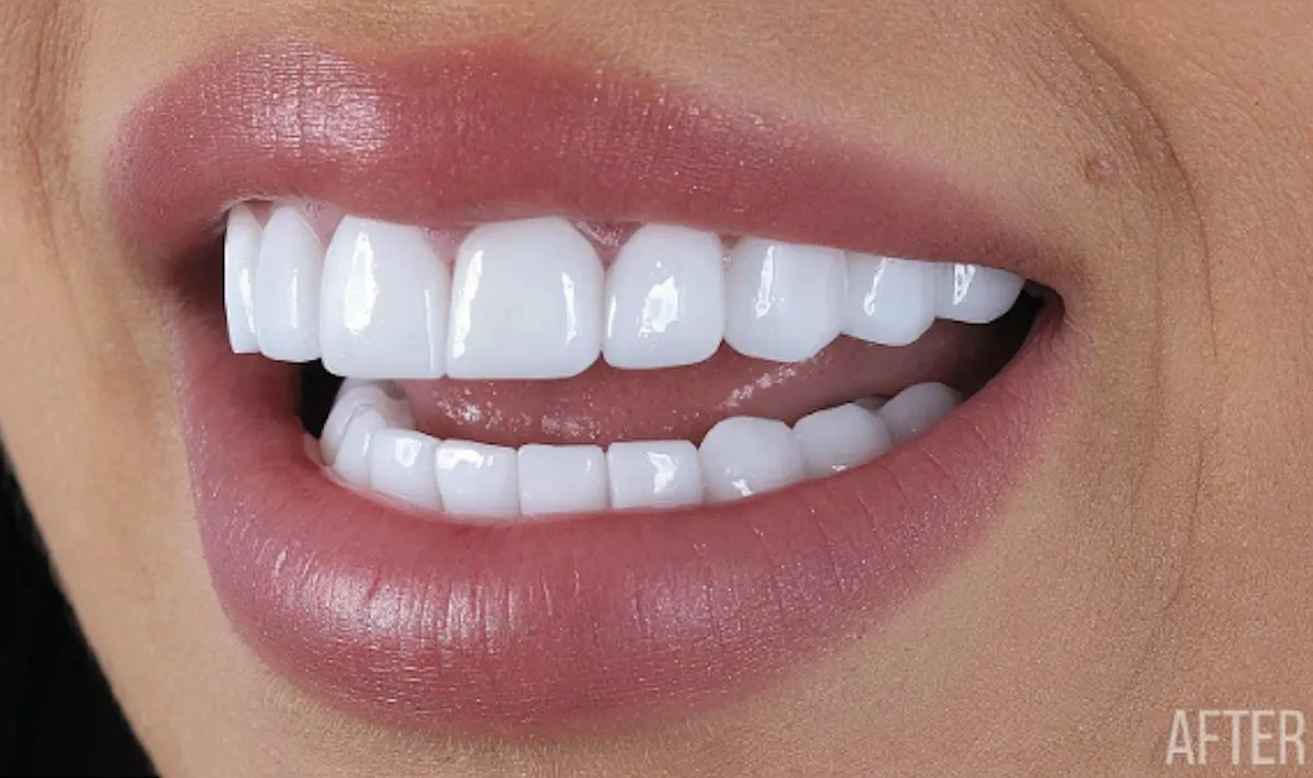 After veneers